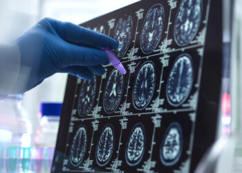 Una anàlisi de sang ja permet confirmar l’alzheimer a l’HTVC