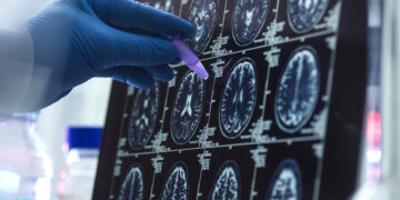 Una anàlisi de sang ja permet confirmar l’alzheimer a l’HTVC